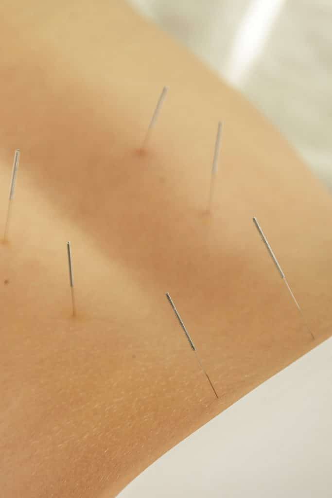 female-back-with-steel-needles-procedure-acupuncture-therapy-683×1024 Acupuncture à Barcelone